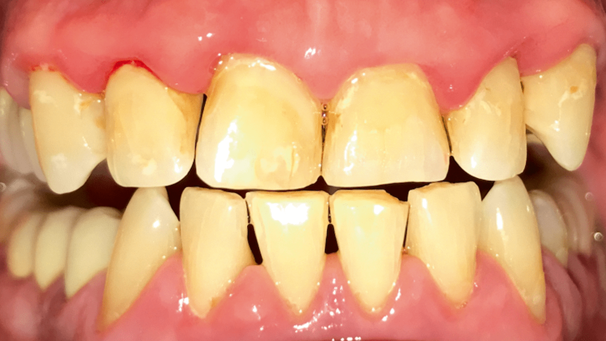 Anfärben Zähne